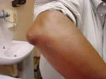 gout%20elbow%20tophus%20clinical.webp