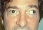 Strabismus-Image-300x210.webp