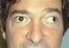 Strabismus-Image-300x210.jpg